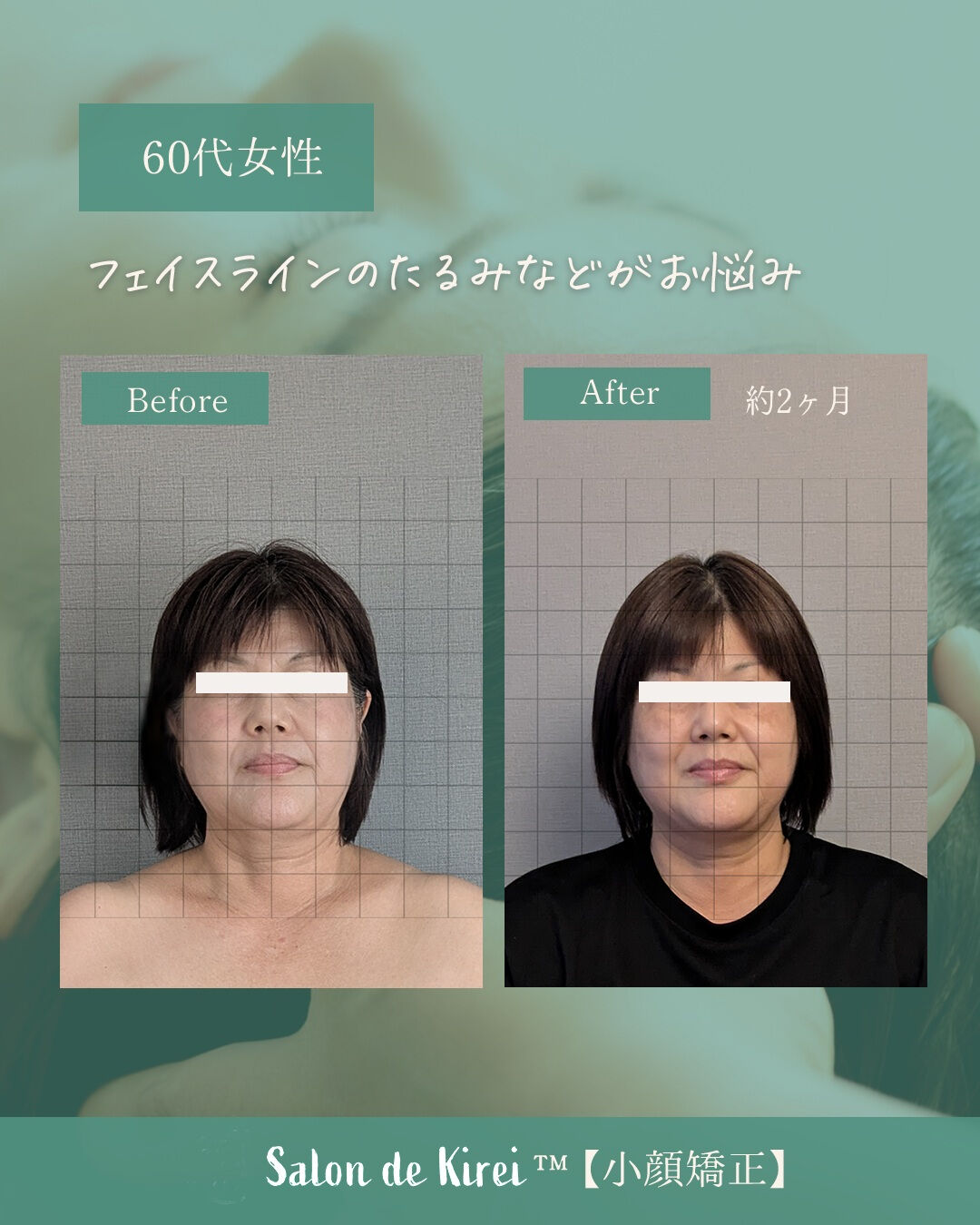 【岡山 倉敷市】リフトアップ・たるみ改善特化/40代からはじ