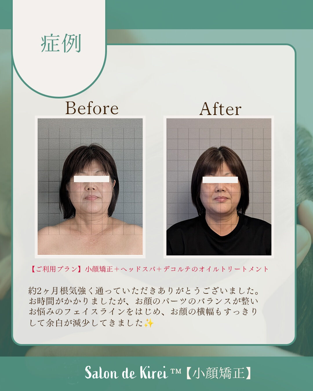 【岡山 倉敷市】リフトアップ・たるみ改善特化/40代からはじ