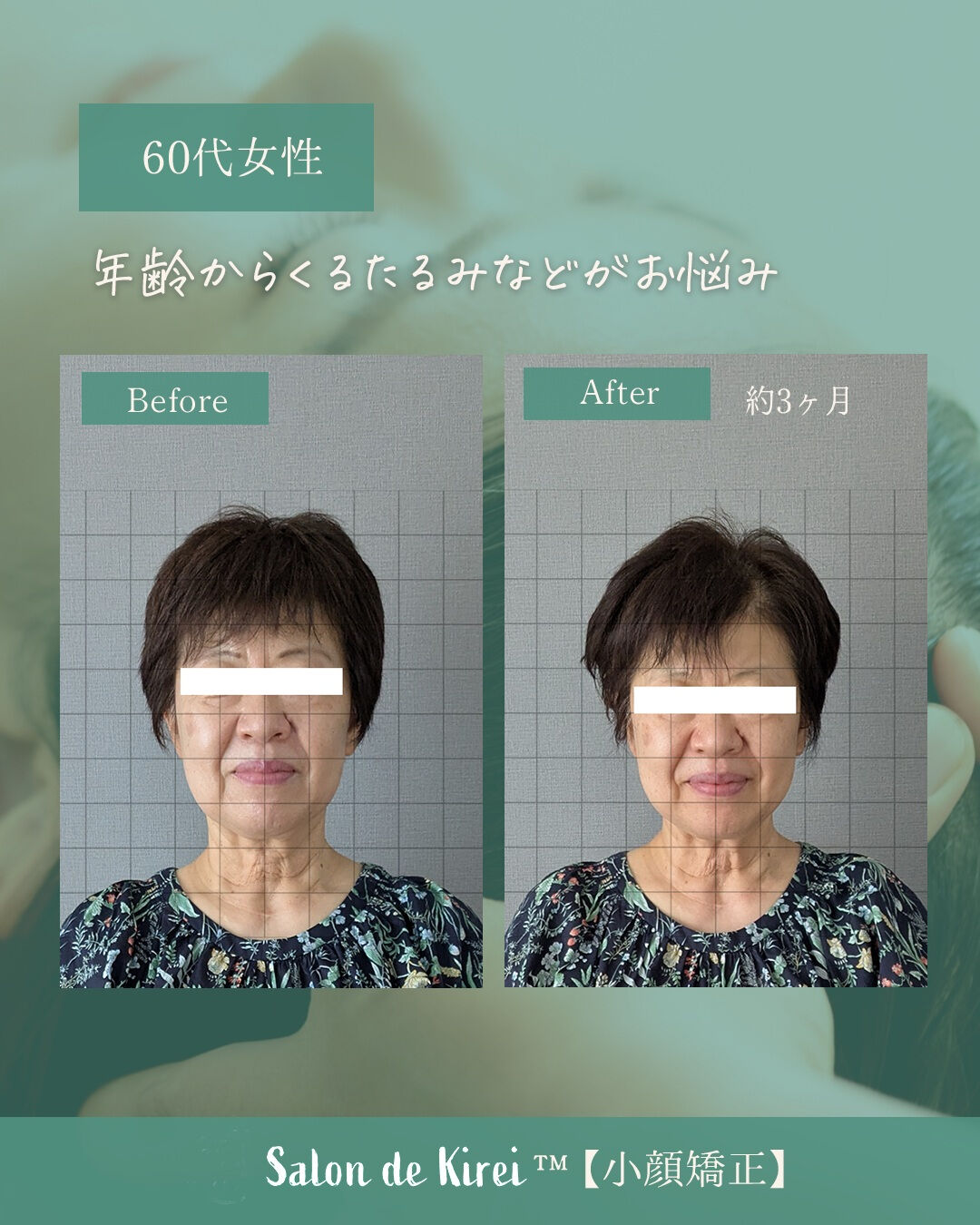 【岡山 倉敷市】リフトアップ・たるみ改善特化/40代からはじ