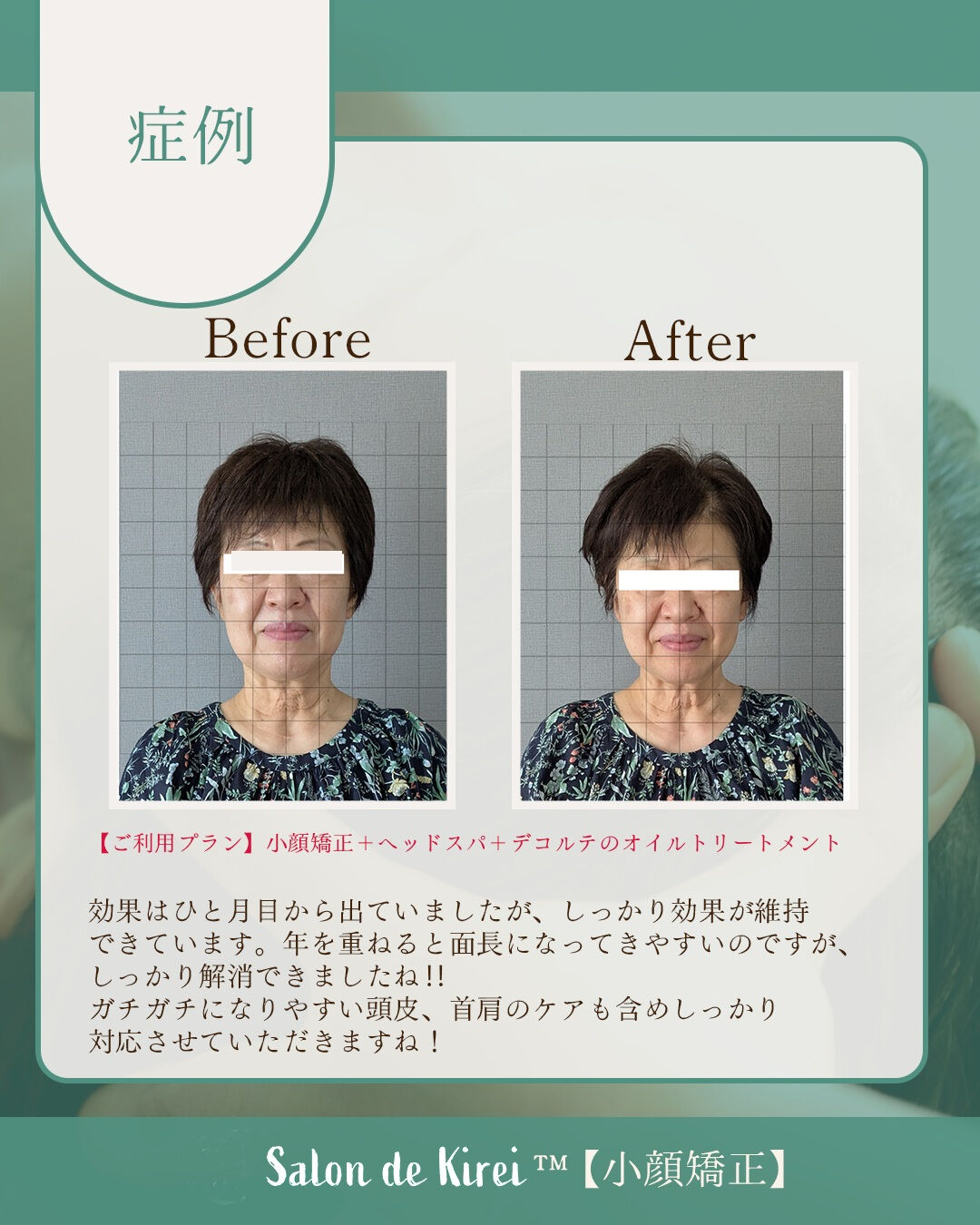 【岡山 倉敷市】リフトアップ・たるみ改善特化/40代からはじ